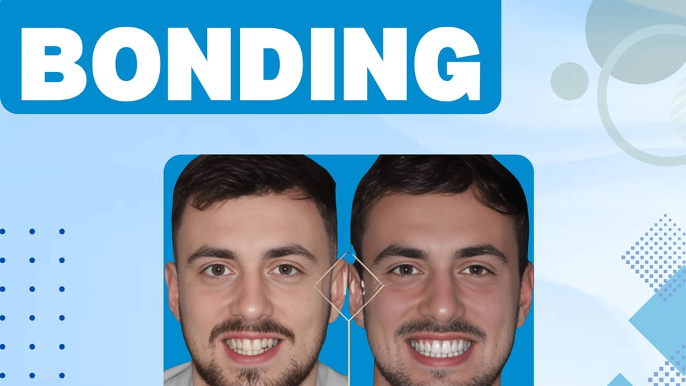 dental bonding treatment in Jaipur