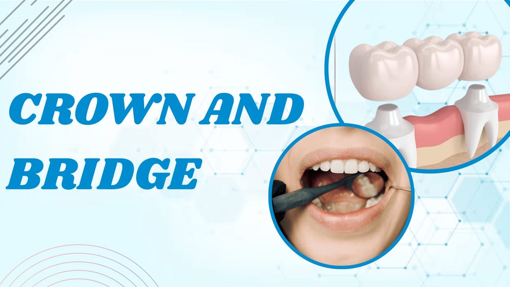 dental crown and bridge treatment in Jaipur